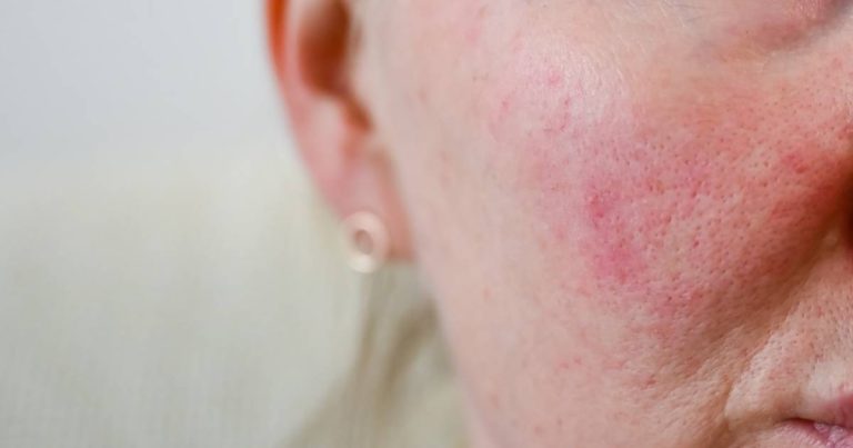 Imagem da notícia: Anvisa autoriza novo uso de medicamento contra lúpus eritematoso sistêmico